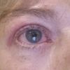 Schwere und angeschwollene Augenlider 4 Wochen nach Oberlidstraffung - 27198