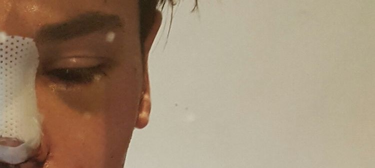 Bananen-Form 1 1/2 Jahre nach Ohrenanlegen mit Ohrläppchenverkleinerung