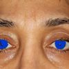Keine Falte am Oberlid an einem Auge: PlexR Behandlung und Oberlidkorrektur - 27207