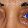 Keine Falte am Oberlid an einem Auge: PlexR Behandlung und Oberlidkorrektur - 27208