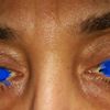Keine Falte am Oberlid an einem Auge: PlexR Behandlung und Oberlidkorrektur - 27209