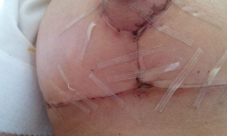 Nässende Stelle an linker Brustnaht nach Brustverkleinerung mit T-Schnitt - 27212