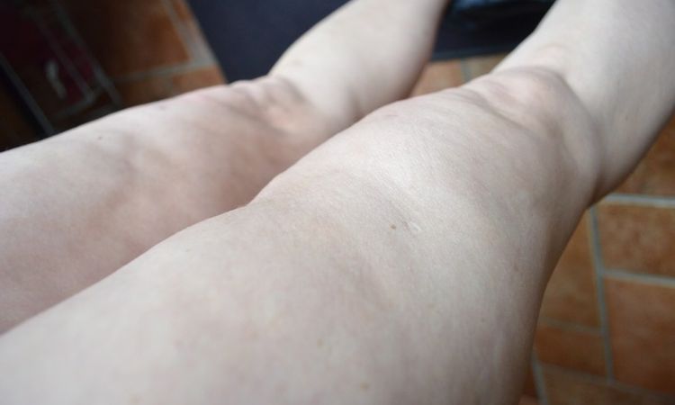 Furchen, Dellenbildung sowie Narbeneinziehung nach Liposuktion von 3 l an Oberschenkelaußen- und Innenseiten - 27213
