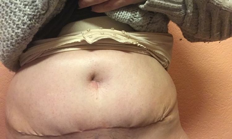 Fett-Haut oberhalb Narbe 7 Wochen nach Bauchstraffung mit Muskelstraffung, 32 Jahre, 3 Kinder - 27227