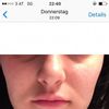 Unharmonische untere Gesichtshälfte: Kinn optisch verkleinern durch Lippenvergrößerung - 27252