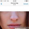Unharmonische untere Gesichtshälfte: Kinn optisch verkleinern durch Lippenvergrößerung - 27253