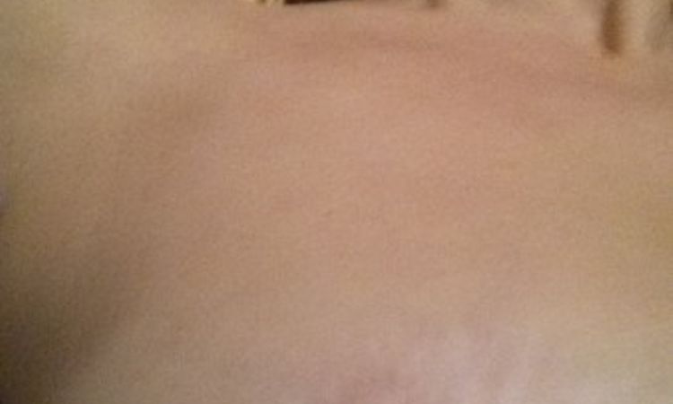 Narbe um Brustwarze extrem gedehnt 2 cm nach Bruststraffung vor 1 Jahr - 27257