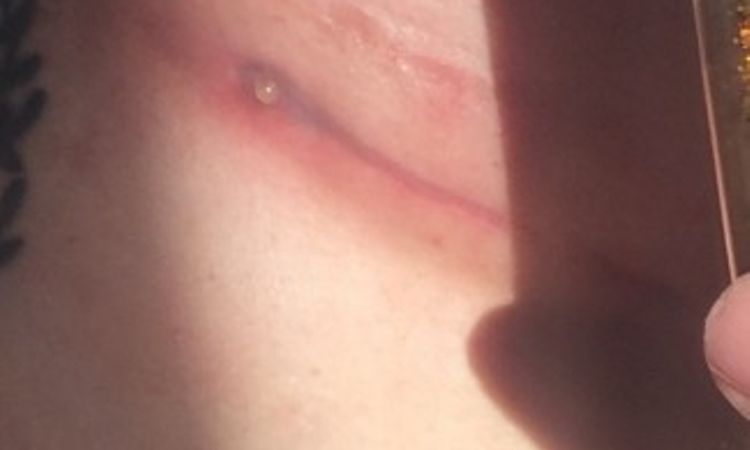 Narbe ok 5 Wochen nach Brustvergrößerung? - 27267