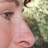 Korrektur der Nasenspitze, große Nasenlöcher