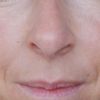 Korrektur der Nasenspitze, große Nasenlöcher