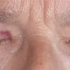 Unterschiedliche Narbenverläufe bei Augenlidkorrektur - 27329