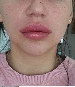 Zu große Lippen nach Unterspritzung mit 0,5ml vor 2 Tagen - 27346