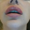 Zu große Lippen nach Unterspritzung mit 0,5ml vor 2 Tagen - 27347