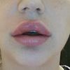 Zu große Lippen nach Unterspritzung mit 0,5ml vor 2 Tagen - 27348