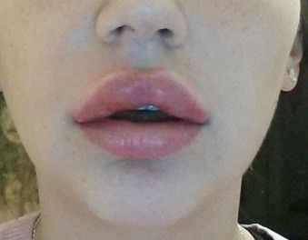 Zu große Lippen nach Unterspritzung mit 0,5ml vor 2 Tagen - 27348