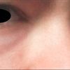 Erblich bedingte Augenringe, 21, männlich - 27370