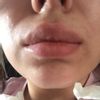 Knoten an Einstichstellen und Schwellungen 7 Monate nach Lippenunterspritzung mit Jeunesse - 27383