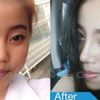 Asiatische Nase: Einlegen von Ohrknorpel oder Silikon