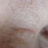 Behandlung der Narbe nach Schnittverletzung am Nasenbein - 27401