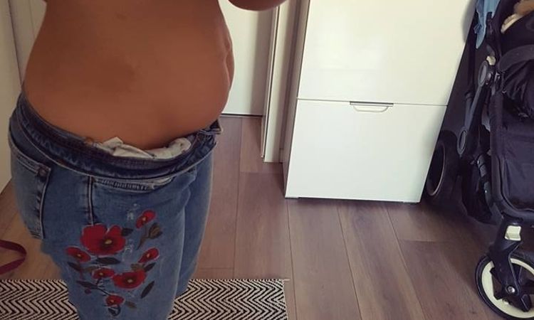 Sehr schlaffe Haut in der Bauchmitte - Bauchstraffung möglich? - 27422