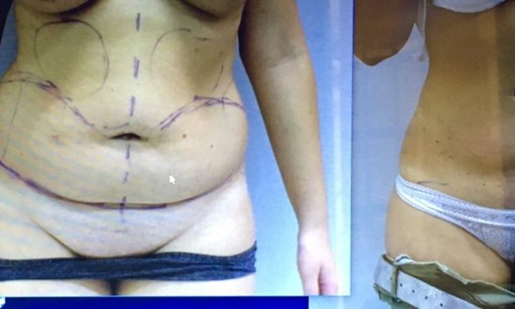Narbe um 5 cm verlegen 2,5 Jahre nach Bauchstraffung - 27433