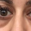Augen unterschiedlich nach Oberlidstraffung und Unterlidkorrektur