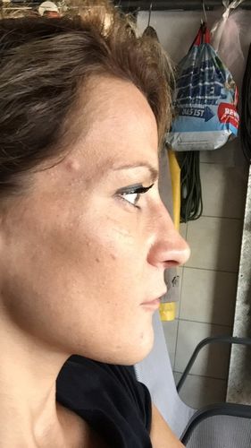 Nasenkorrektur nach Hyaluron-Behandlung