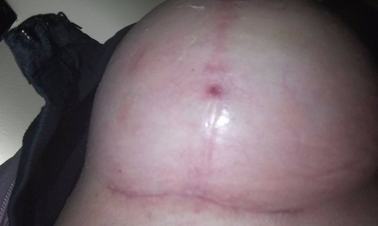 Eiterpickel auf Narbe 5 Wochen nach Bruststraffung mit Impl. - 27517