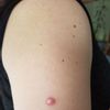 Keloid oder hypertrophe Narbe nach Entfernung von Muttermalen