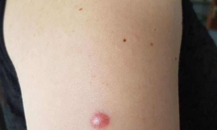 Keloid oder hypertrophe Narbe nach Entfernung von Muttermalen - 27528