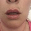 Lippe blau und schief nach Behandlung mit Hyaluron - 27562