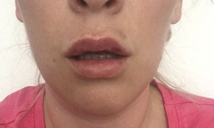 Lippe blau und schief nach Behandlung mit Hyaluron - 27562