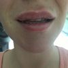 Lippe blau und schief nach Behandlung mit Hyaluron - 27563