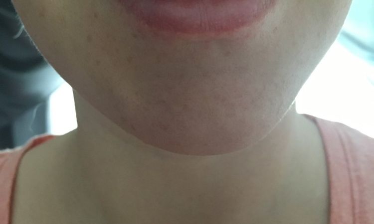 Lippe blau und schief nach Behandlung mit Hyaluron - 27563