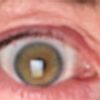 Oberlidstraffung vor 7 Wochen: mehr Haut an einem Auge - 27568