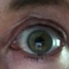 Oberlidstraffung vor 7 Wochen: mehr Haut an einem Auge - 27569