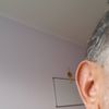 Ohrenkorrektur mit Earford und Ohrläppchenverkleinerung - 27572