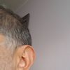 Ohrenkorrektur mit Earford und Ohrläppchenverkleinerung - 27573