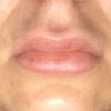 Extreme Schwellung nach 2. Lippenunterspritzung - 27574