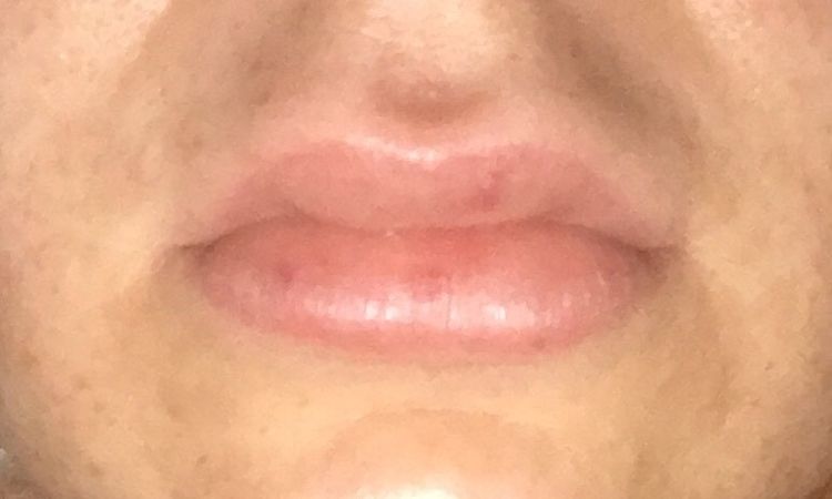 Extreme Schwellung nach 2. Lippenunterspritzung - 27574