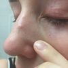 Gelblicher Knubbel auf der Nase 5 Wochen nach Nasenkorrektur - 27576