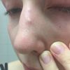 Gelblicher Knubbel auf der Nase 5 Wochen nach Nasenkorrektur - 27577