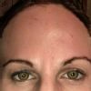 Sehr hohe Stirn: Augenbrauenhebung und Haartransplantation - 27581