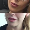 Lippenvergrößerung: Alternative zu Hyaluronsäure - 27584