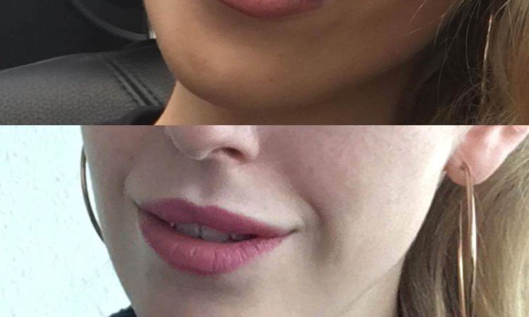 Lippenvergrößerung: Alternative zu Hyaluronsäure - 27584