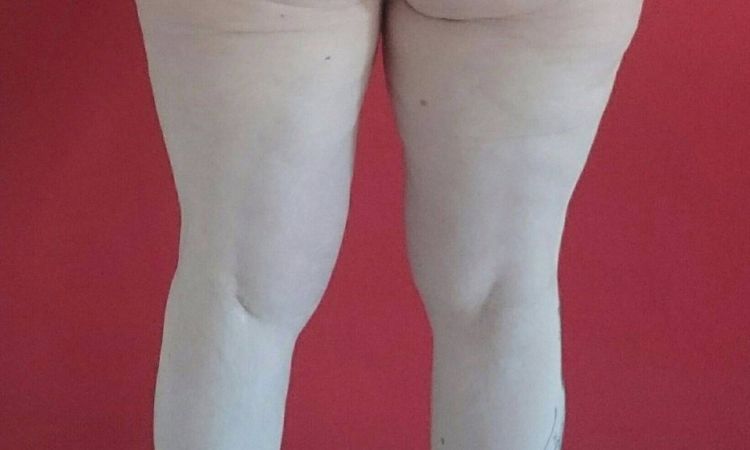 Kaum ein Unterschied 5 Wochen nach BodyTite Liposuktion von 5,5 l - 27595