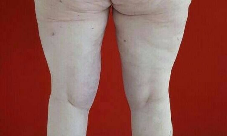 Kaum ein Unterschied 5 Wochen nach BodyTite Liposuktion von 5,5 l - 27596