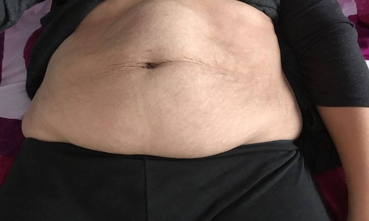 Bauchstraffung mit Rektusdiastase oder Hernie am Oberbauch nach Schwangerschaft in Essen - 27603