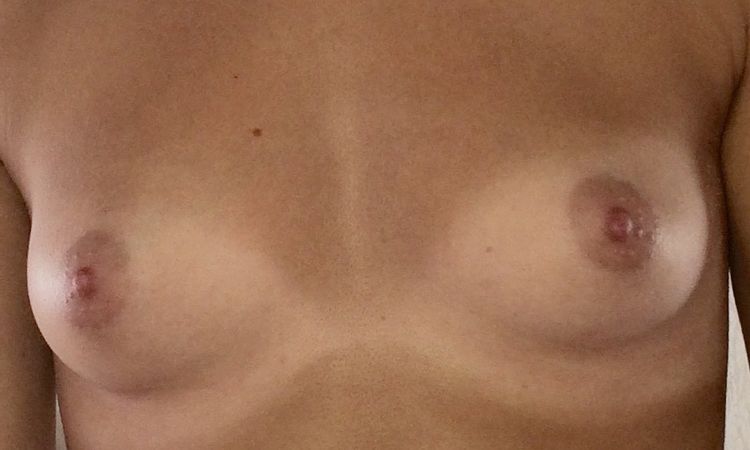 Implantatwahl vor Brustvergrößerung, 270 ml UBM high Profil, 166 cm, 52 kg - 27607