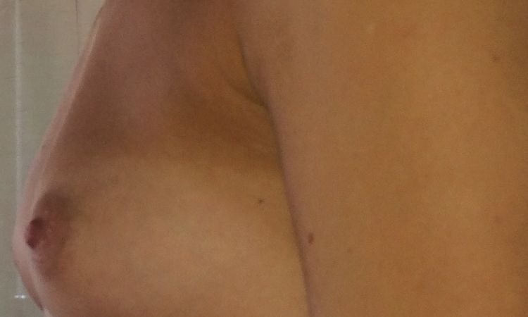 Implantatwahl vor Brustvergrößerung, 270 ml UBM high Profil, 166 cm, 52 kg - 27608